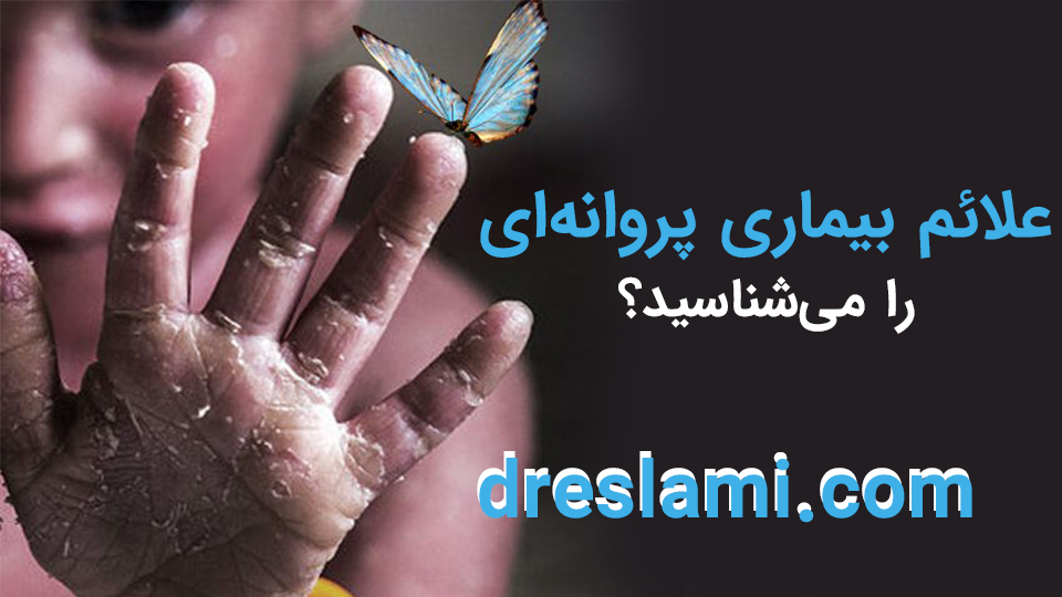 علائم بیماری پروانه ای