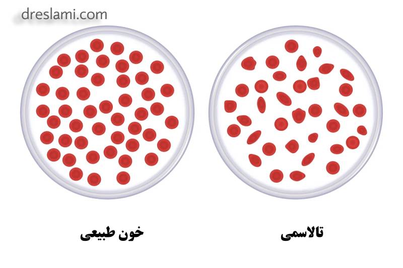 بیماری تالاسمی، ناشی از جهش ژن های مربوط به هموگلوبین است