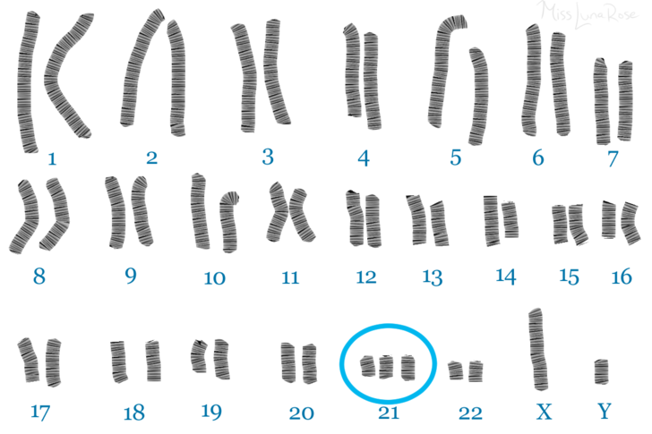 اختلال کروموزوم ها در سندروم داون 