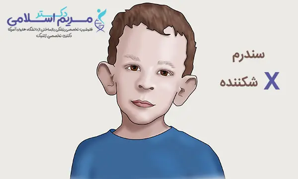 علائم و درمان سندرم ایکس شکننده